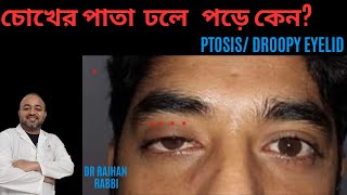 চোখের পাতা পড়া রোগ টোসিস | Ptosis treatment lচোখের পাতা পড়া বা টসিস (Ptosis) কি ও কেন হয়? ptosis !