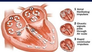 Atrial Fibrillation - Cardiology PowerPoint Presentation