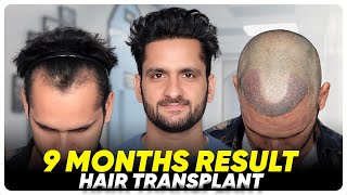 Hair Transplant in Shimoga | Best Results \u0026 Cost of Hair Transplant in Shimoga