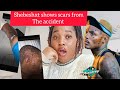 Shebeshxt shows scars he got from the accident// Very bad