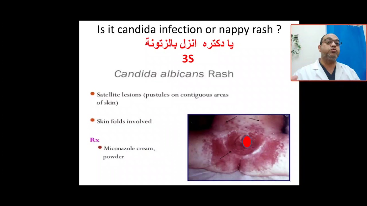 Candidal Diaper Rash Vs Diaper Dermatitis