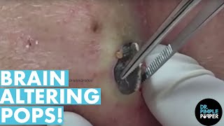 The POPS That Altered My Brain Chemistry! 20 Minutes! Dr Pimple Popper Best Of