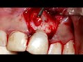 CIRURGIA PARENDODÔNTICA | Como se trata a INFECÇÃO DENTÁRIA com cirurgia [PROCEDIMENTO COMPLETO]