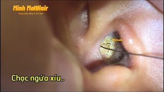 Anh trai  với cục ráy tai - lấy ráy tai- asmr- Earwax- MinhMenHair