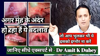 अगर मुंह के अंदर हो रहा है ये बदलाव। change inside mouth। somthing dengerous 😱