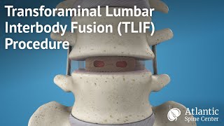 Transforaminal Lumbar Interbody Fusion (TLIF) Procedure