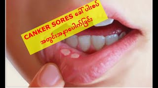 Canker sores ပါးစပ်ထဲ အနာကို အိမ်တွင်ဘယ်လိုကုသမလဲ