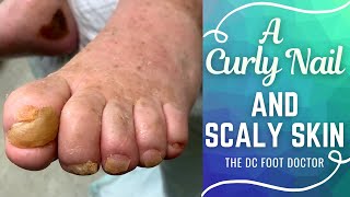 A Curly Nail and Scaly Skin