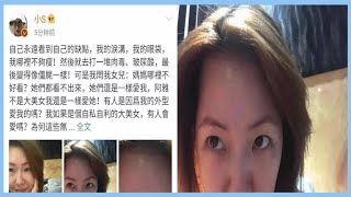 小S發文承認打玻尿酸過度導致面癱，教訓慘痛，岳云鵬評論引熱議！