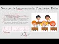 nonspecific intraventricular conduction delay