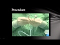 Master Class on Laparoscopic Gastric Bypass by Dr. R.K. Mishra