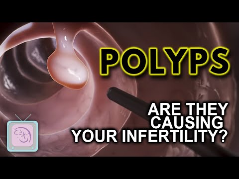 What is CPT code for vaginal polyp removal?