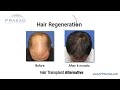 Hair Regeneration Non-Surgical Hair Transplant Alternative that Can Stop Further Hair Loss