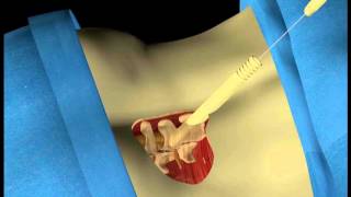 ZYFUSE™ Facet Fixation System