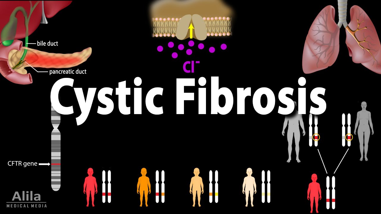 Cystic Fibrosis: Pathophysiology, Genetics, Symptoms, Diagnosis And ...