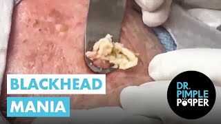 Blackhead Mania