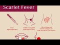 Scarlet Fever or Scarlatina ; Causes, Symptoms, Diagnosis, Prevention and Treatment