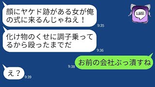 顔にヤケドの跡がある私を見下し、結婚式で突然腹を殴った妹の婚約者が「化け物は消えろｗ」と言った。その性悪な男に私の真実を教えた時の反応が面白かった。