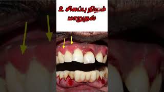 ஈறு பிணியின் (peridontitis) 5 அறிகுறிகள்!!