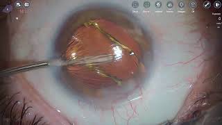 Dr.Stanimir Troshev Cataract Surgery Livestream ACUNEX Vario