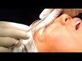 Cirugía de Blefaroplastia (párpado inferior)