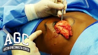 Unilateral Gynecomastia Surgery - Male Breast On One Side - Austin Gynecomastia Center