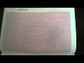 EKG ECG electrocardiogram Cardiologist Cardiology www.drbenzur.com