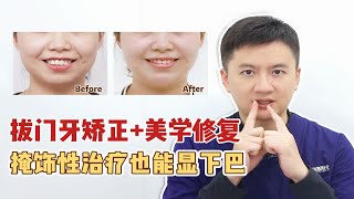 拔门牙矫正+美学修复  不正颌 下巴也能“无中生有”