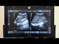 Introducing the Follow Up Tool on Venue™ Family POCUS