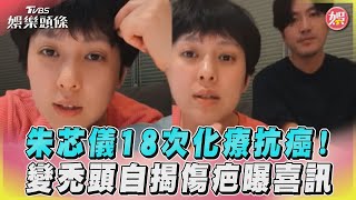 朱芯儀18次化療抗癌！　變禿頭自揭傷疤曝喜訊｜TVBS娛樂頭條@tvbsforfun