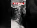 metastatic spread of cancer to the spine shorts medical doctor