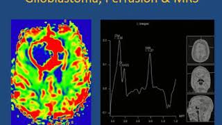 naurorradiologia   tumores cerebrales adultos