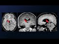 Contralateral Transcallosal-Transchoroidal Approach for a Medial Thalamic Cavernous Malformation