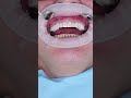 dental veneers in prague shorts dentist dental veneers short