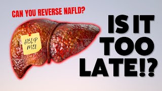 NAFLD: How to Treat and Reverse Non-Alcoholic Fatty Liver Disease