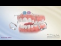 Bluegrass Appliance - Orthodontic Appliance