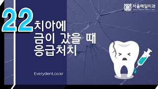 골라보는 치과상식 Q\u0026A 쩍!치아에 금이갔을때 현명한 응급처치는?