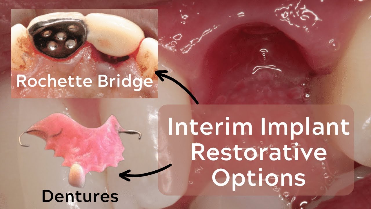 Rochette Bridges And Provisional Prostheses For Implants – PDP145 - YouTube