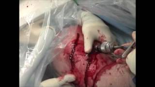 Percutaneous Fixation of Proximal Humeral Fractures