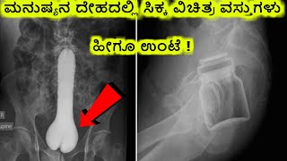 crazy things found in human body || ಮಾನವನ ದೇಹದಲ್ಲಿ ಸಿಕ್ಕ ವಿಚಿತ್ರ ವಸ್ತುಗಳು