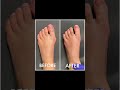 Collection Of Bunion Transformations #Shorts