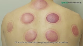 What You Need to Know about Cupping