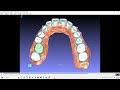 guidemia automatic aligner design