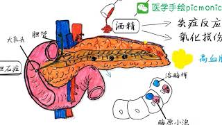 ＃医学手绘| 急性胰腺炎 AP Acute Pancreatitis