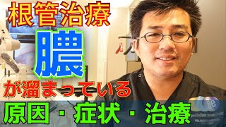 【根管治療の膿】膿が溜まっている原因・症状・治療とは