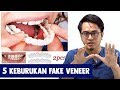 5 Keburukan Fake Veneer