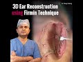 3D Ear reconstruction using Firmin Technique | #transformationsbydrt  #shorts #youtubeshorts