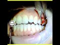 Peripheral Ossifying Fibroma Excision on Buccal Gingiva