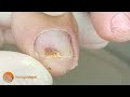 trimming and cleaning this problematic toenail podología integral