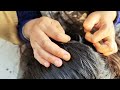 Omg 😱 Too much Lice with real sound video||Asmr Pakistan